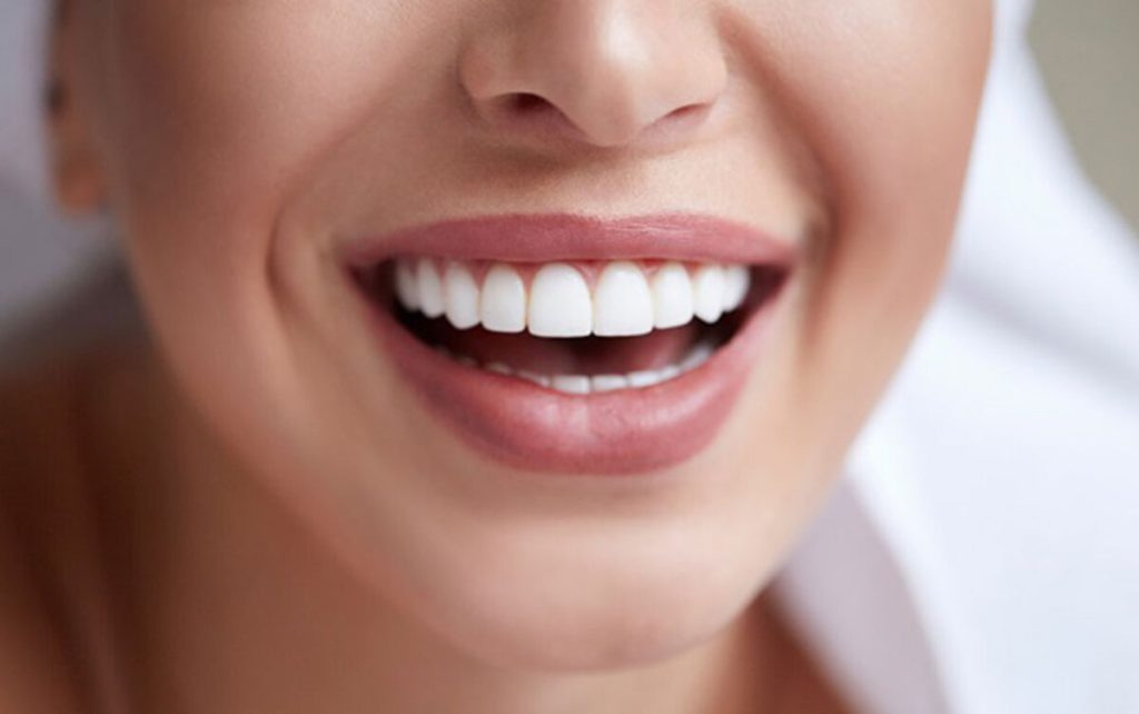 لمینت سرامیکی در اردبیل