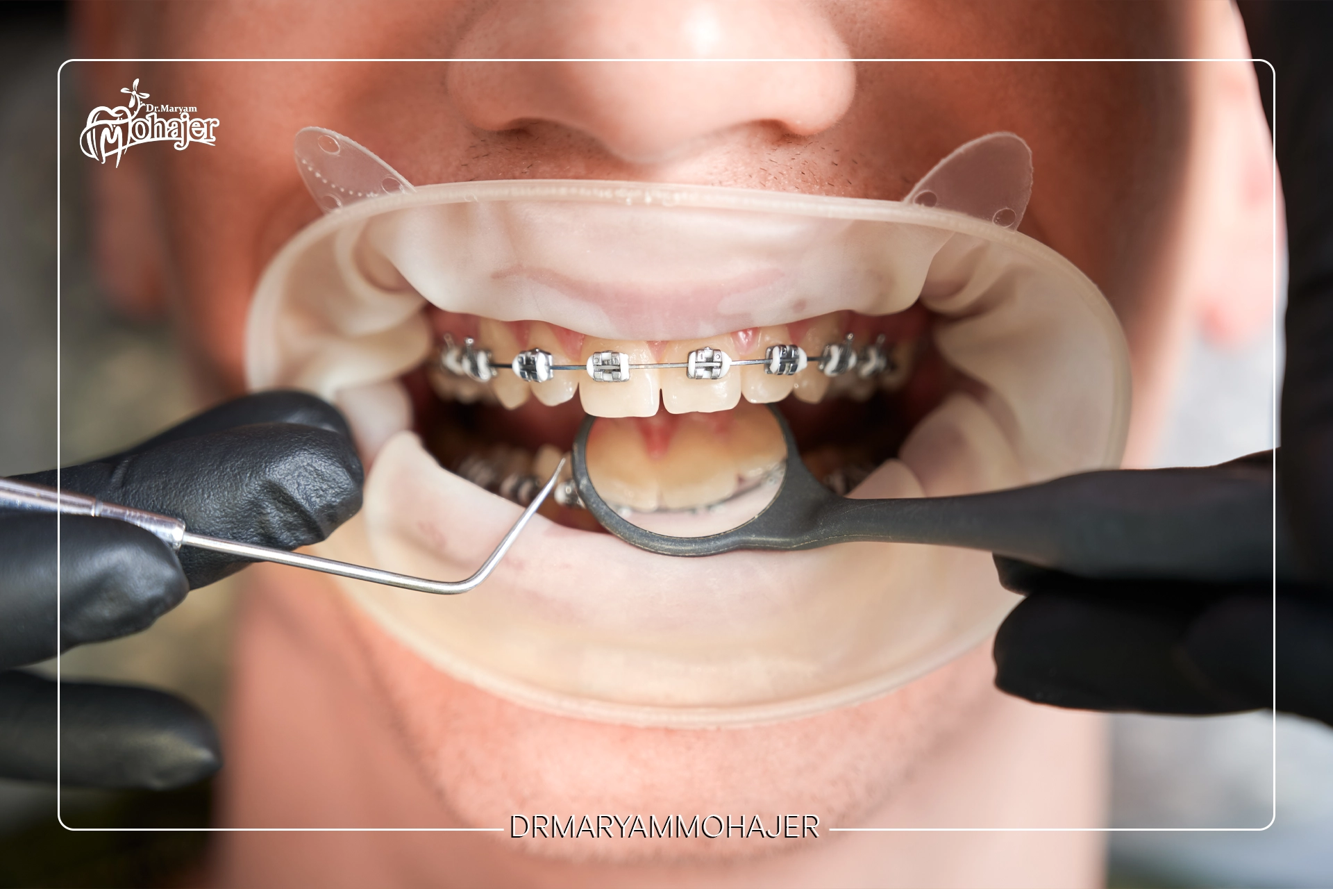 بررسی ارتودنسی ثابت و متحرک؛ کدام بهتر است؟
