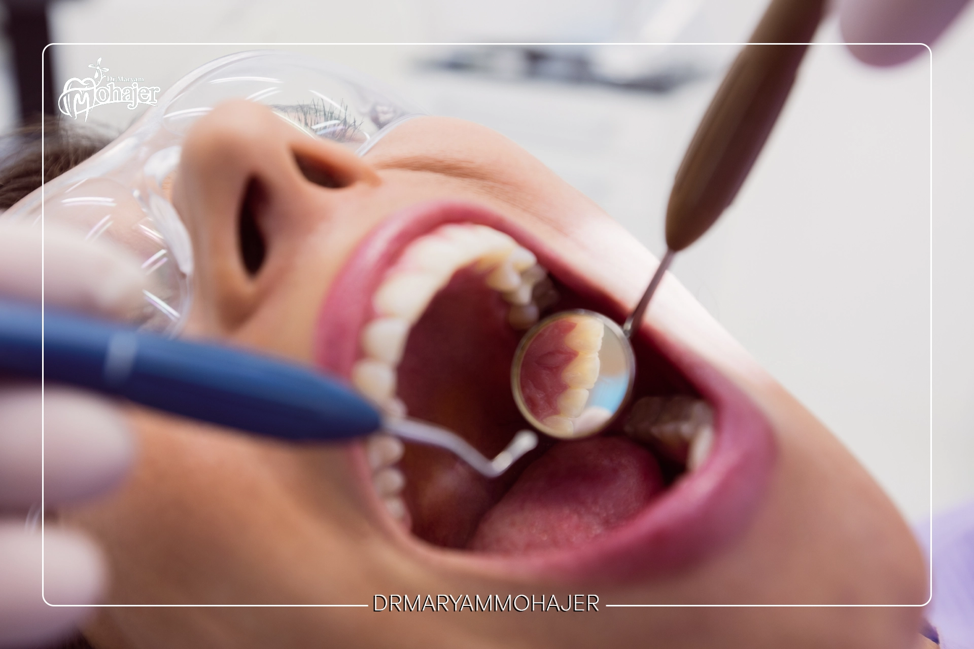 ترمیم دندان با آمالگام یا کامپوزیت؟ مقایسه ظاهری و عملکردی
