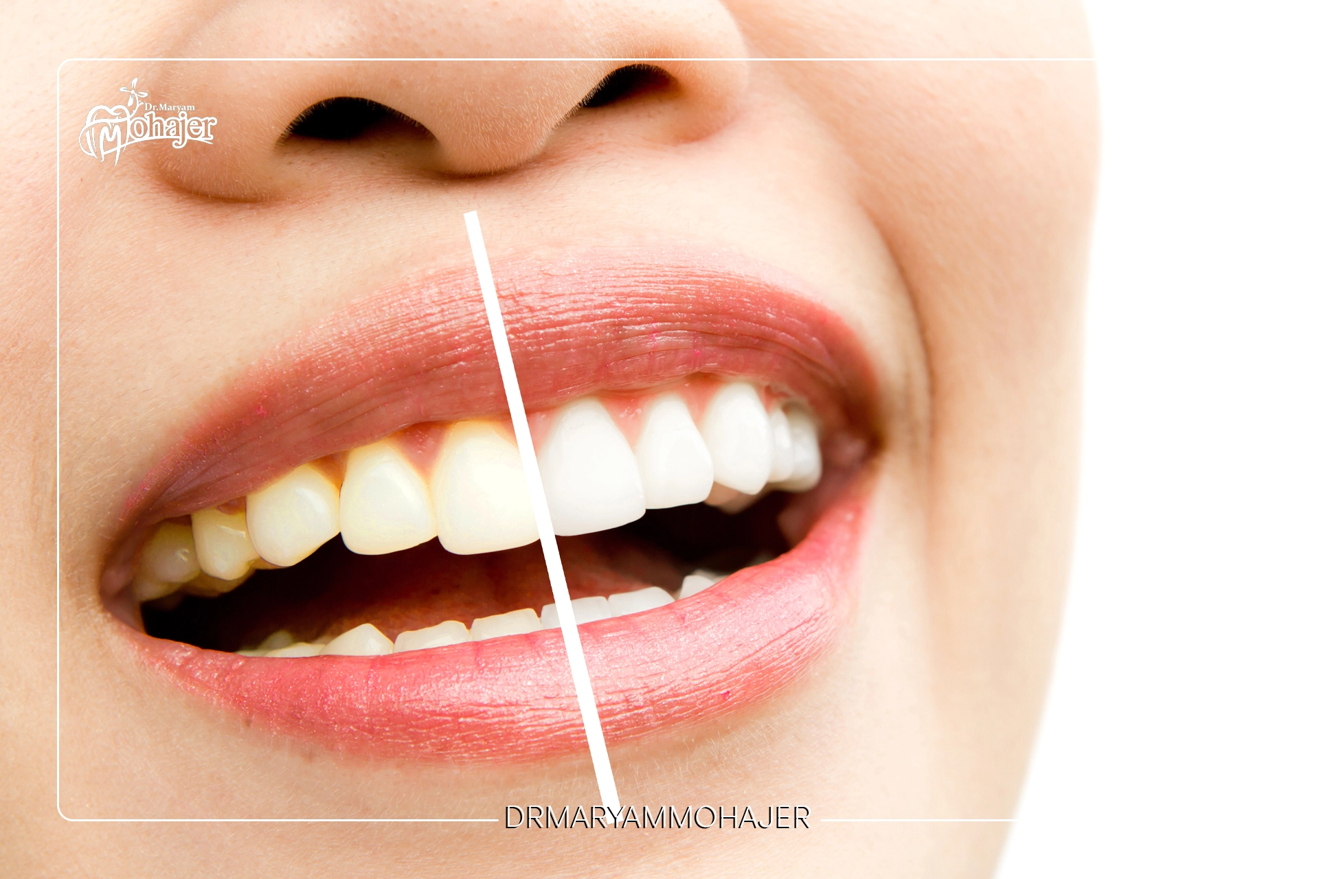 آیا بلیچینگ به دندان آسیب میرساند؟ عوارض بلیچینگ دندان