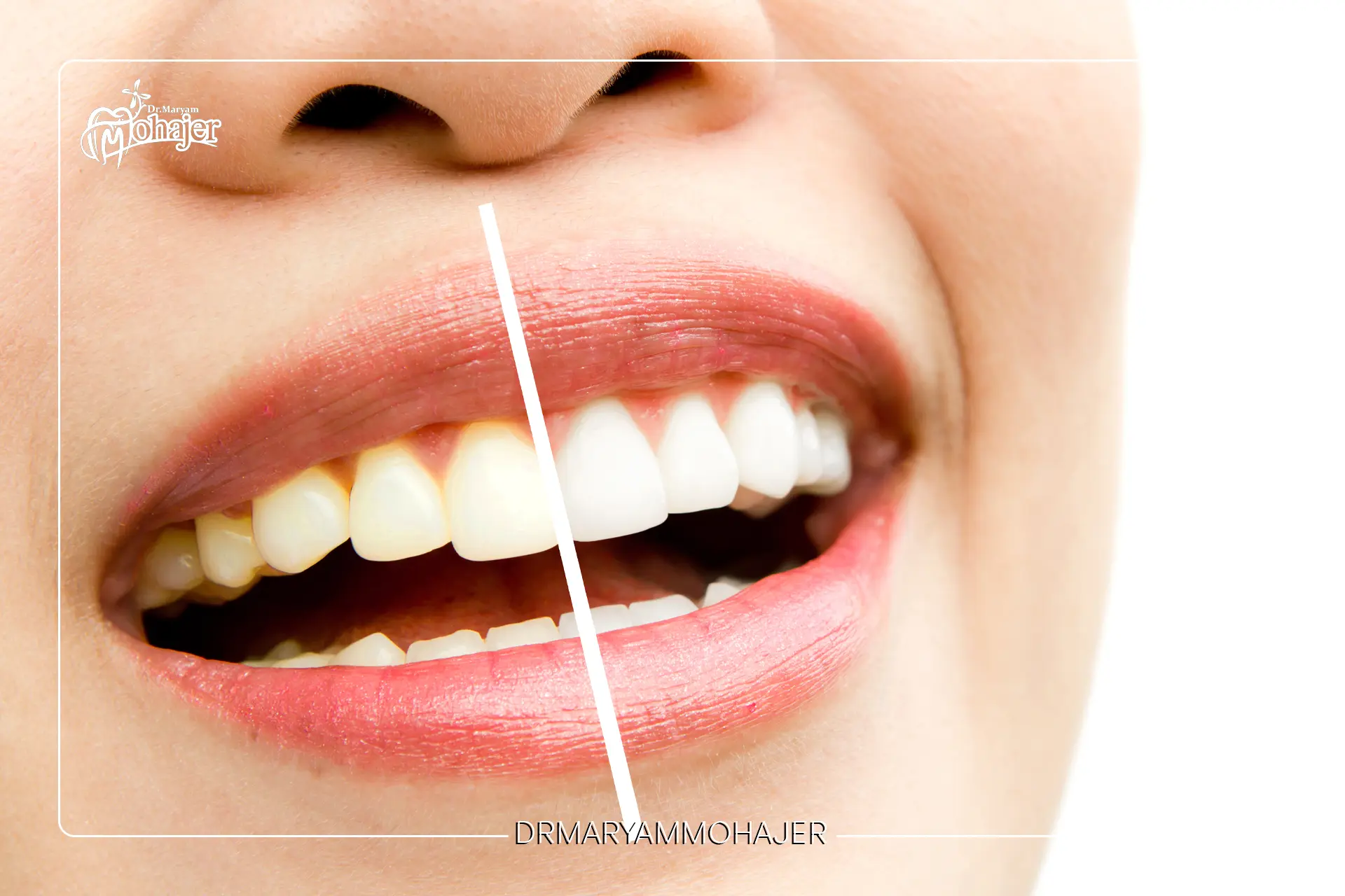 تفاوت بلیچینگ دندان با لمینت و کامپوزیت؛ کدام روش بهتر است؟