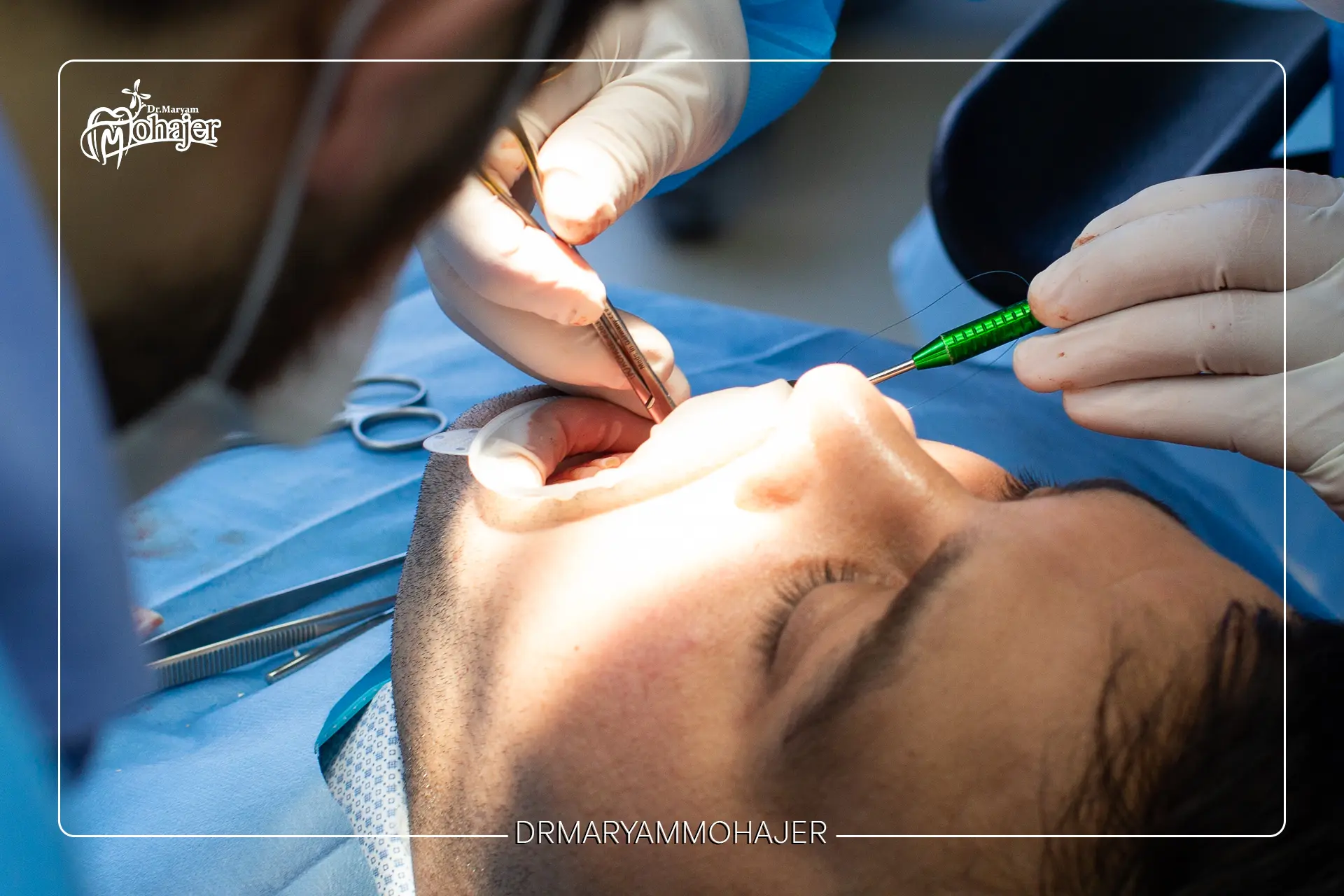 تفاوت جرم گیری عمیق و جراحی لثه؛ چه زمانی جراحی تنها راه حل است؟