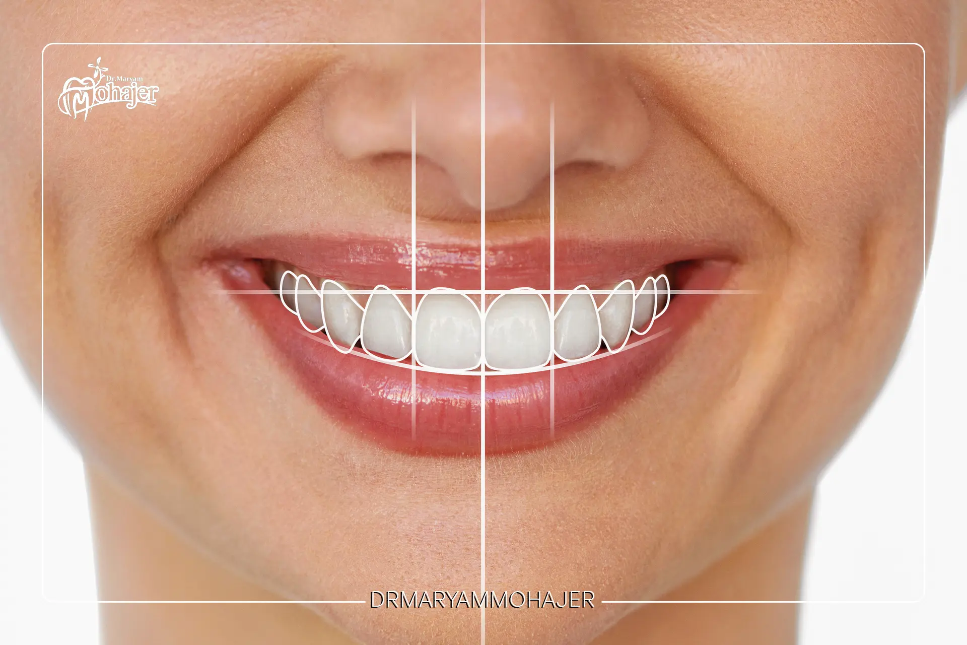 مراحل طراحی لبخند در مطب دندانپزشکی؛ از مشاوره تا لبخند نهایی