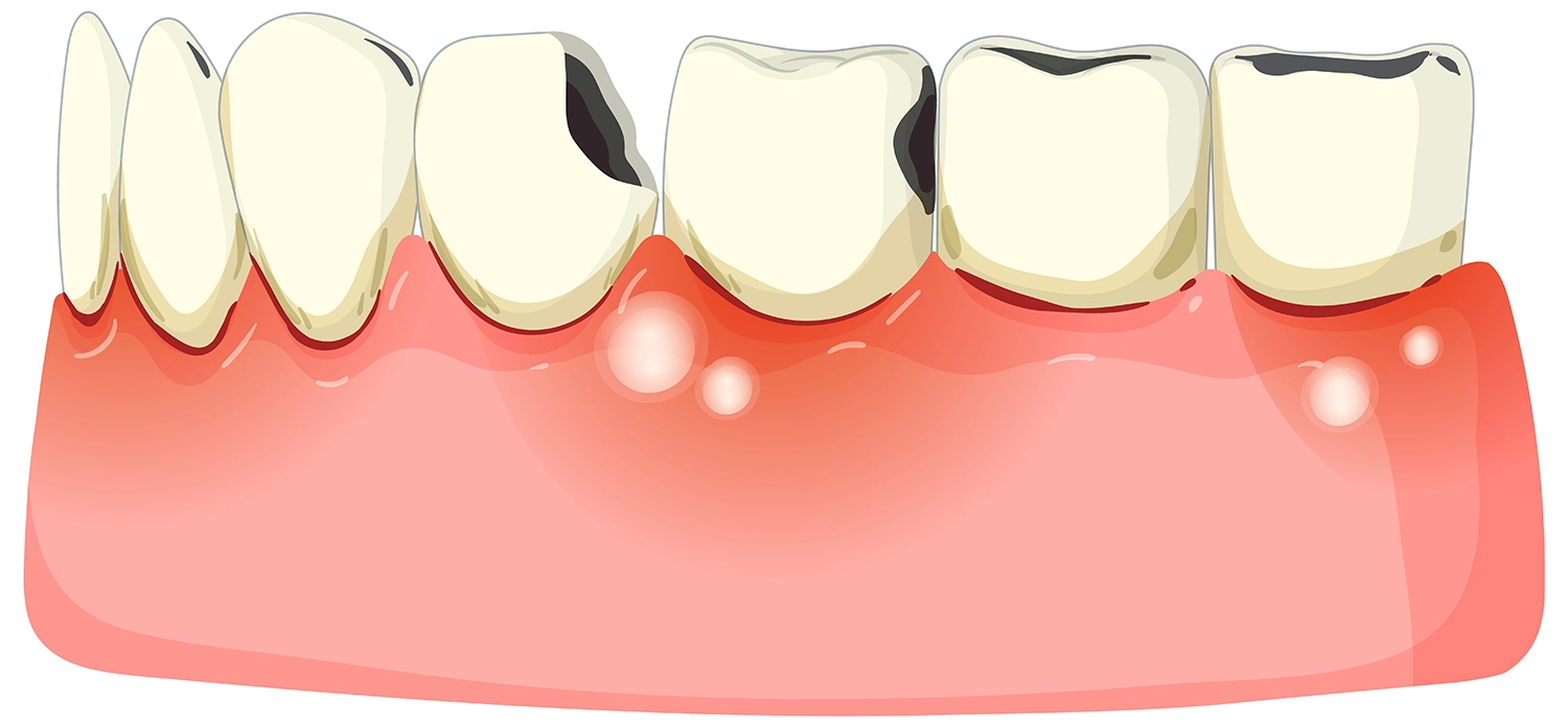 بررسی 8 عارضه جراحی لثه؛ آیا جراحی لثه خطرناک است؟