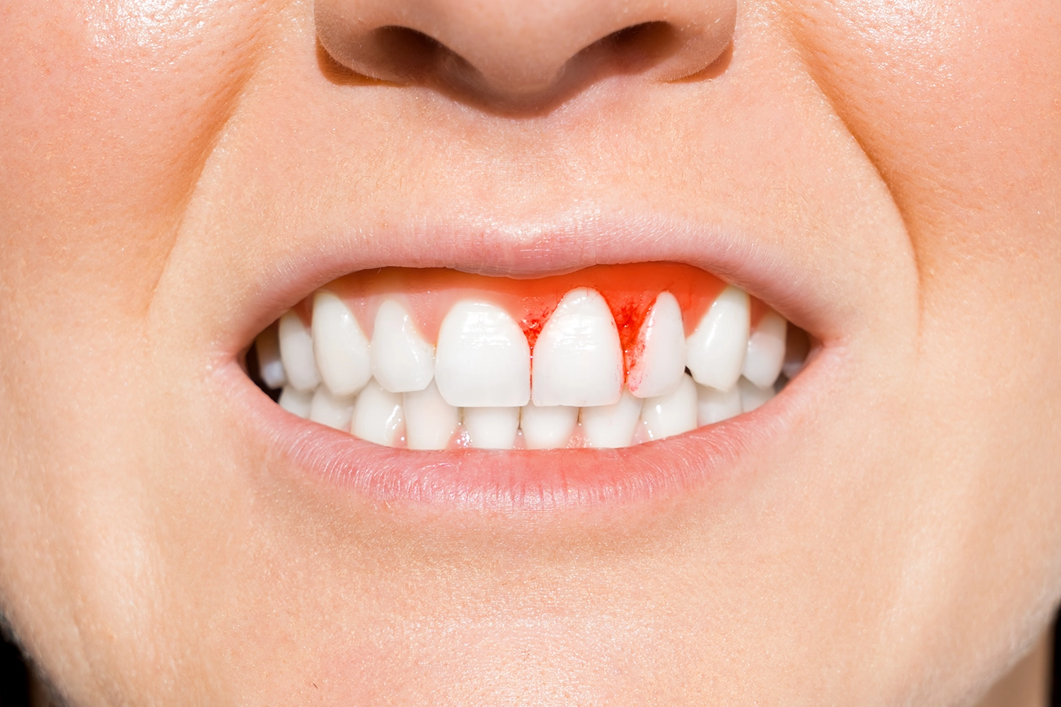 بررسی 8 عارضه جراحی لثه؛ آیا جراحی لثه خطرناک است؟