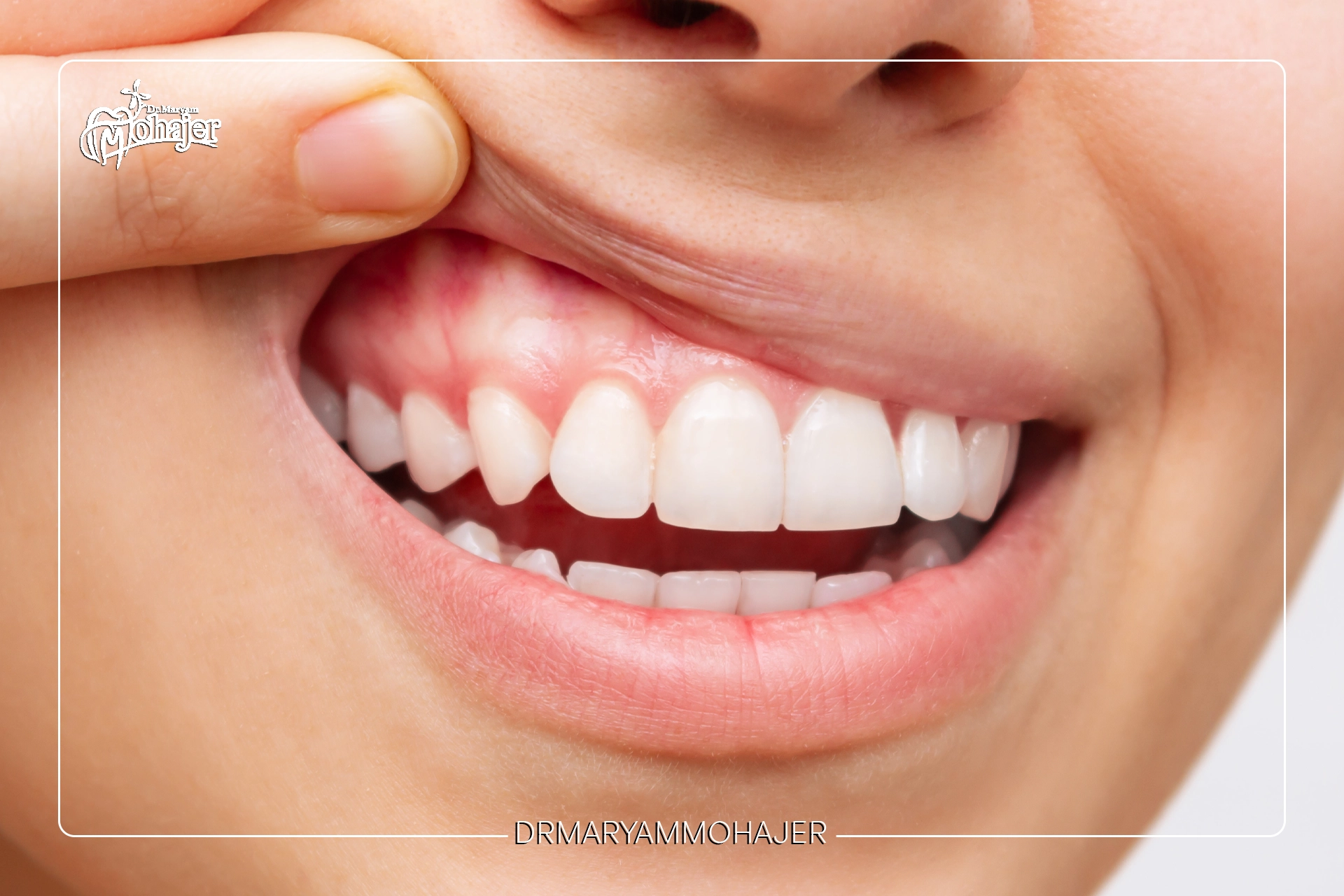 بررسی 8 عارضه جراحی لثه؛ آیا جراحی لثه خطرناک است؟