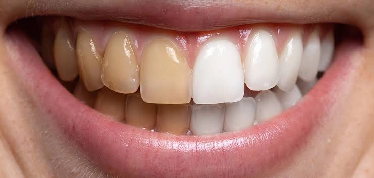 علت بازگشت رنگ دندان بعد از بلیچینگ چیست؟