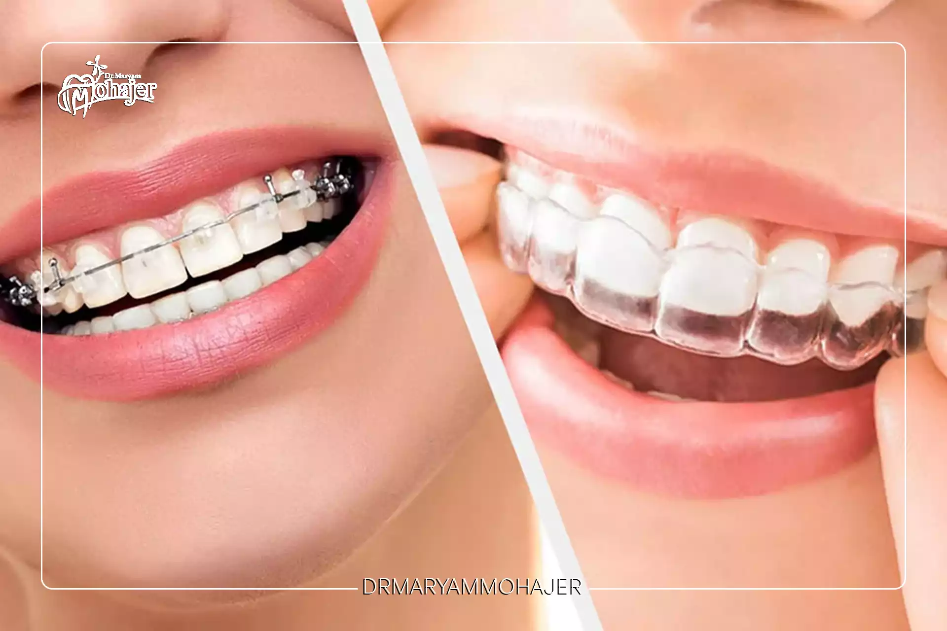 ارتودنسی ثابت یا نامرئی؟ مقایسه کامل مزایا و معایب