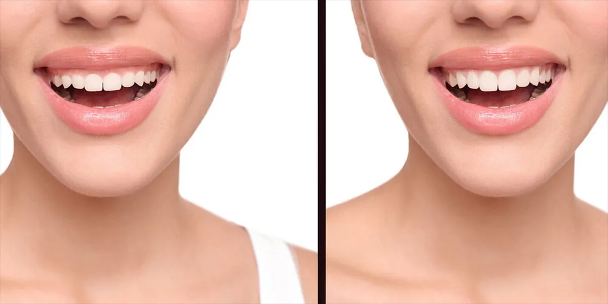 آیا جراحی لثه درد دارد؟ تجربه بیماران و روش های کاهش درد