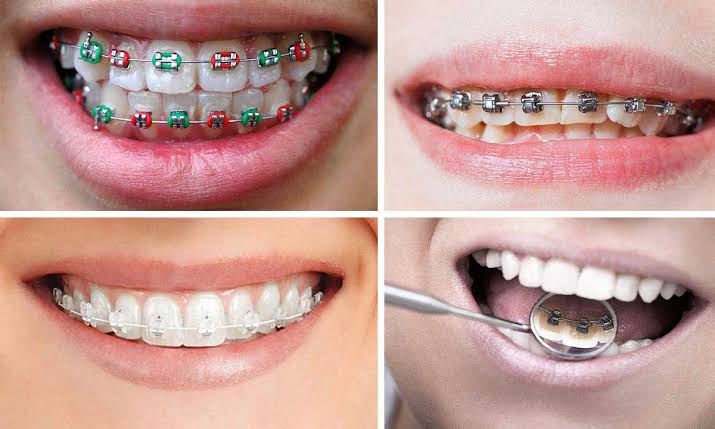 ارتودنسی ثابت یا نامرئی؟ مقایسه کامل مزایا و معایب