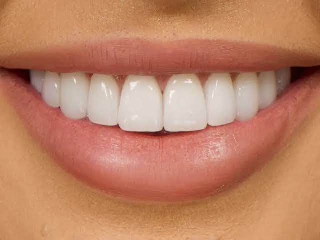 7 نکته مهم که قبل از لمینت سرامیکی باید بدانید