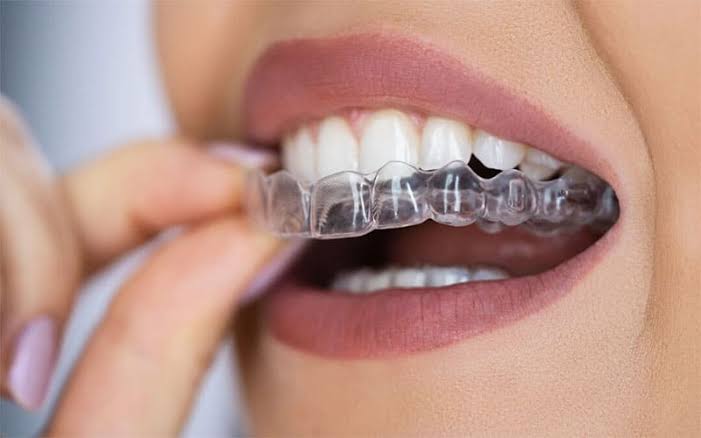 ارتودنسی ثابت یا نامرئی؟ مقایسه کامل مزایا و معایب