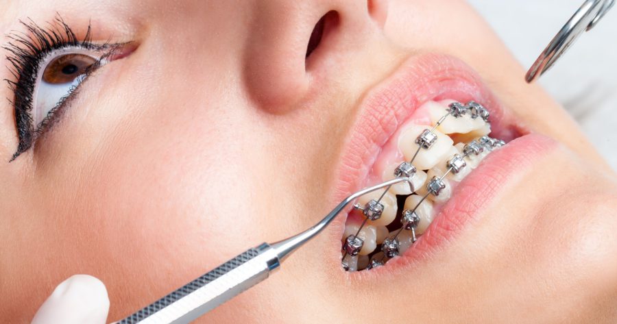 ارتودنسی ثابت یا نامرئی؟ مقایسه کامل مزایا و معایب