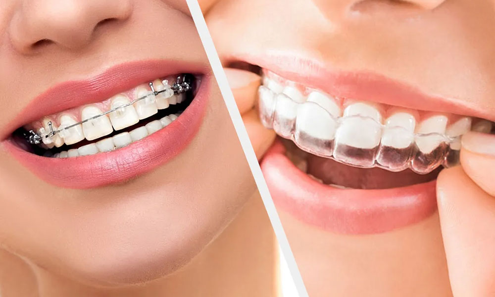 ارتودنسی ثابت یا نامرئی؟ مقایسه کامل مزایا و معایب